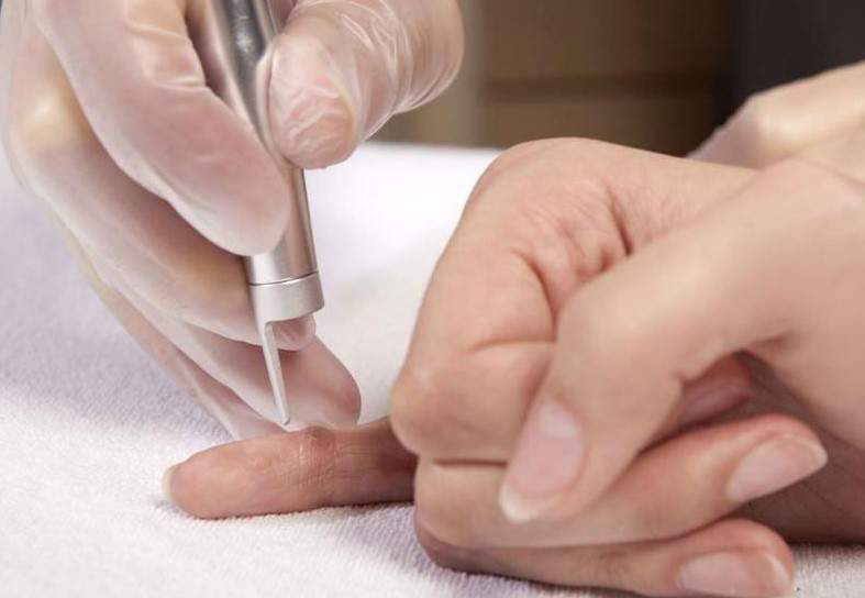 How Do You Remove Warts Naturally? How Do You Remove Warts Naturally?