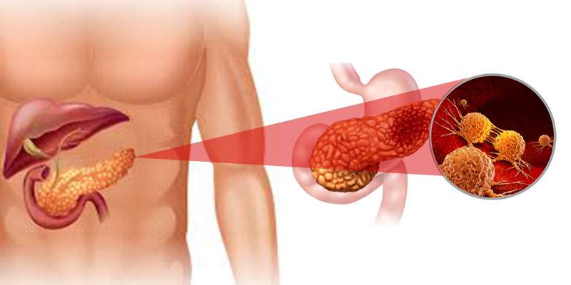 Pancreatic Cancer Symptoms