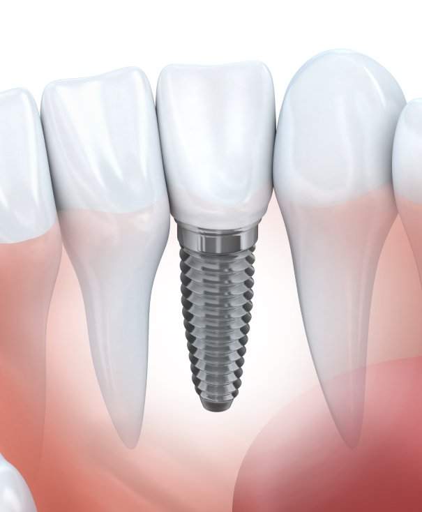 The Impact of Dentures on Quality of Life