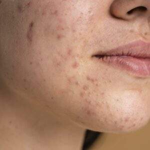 young woman with acne close up.