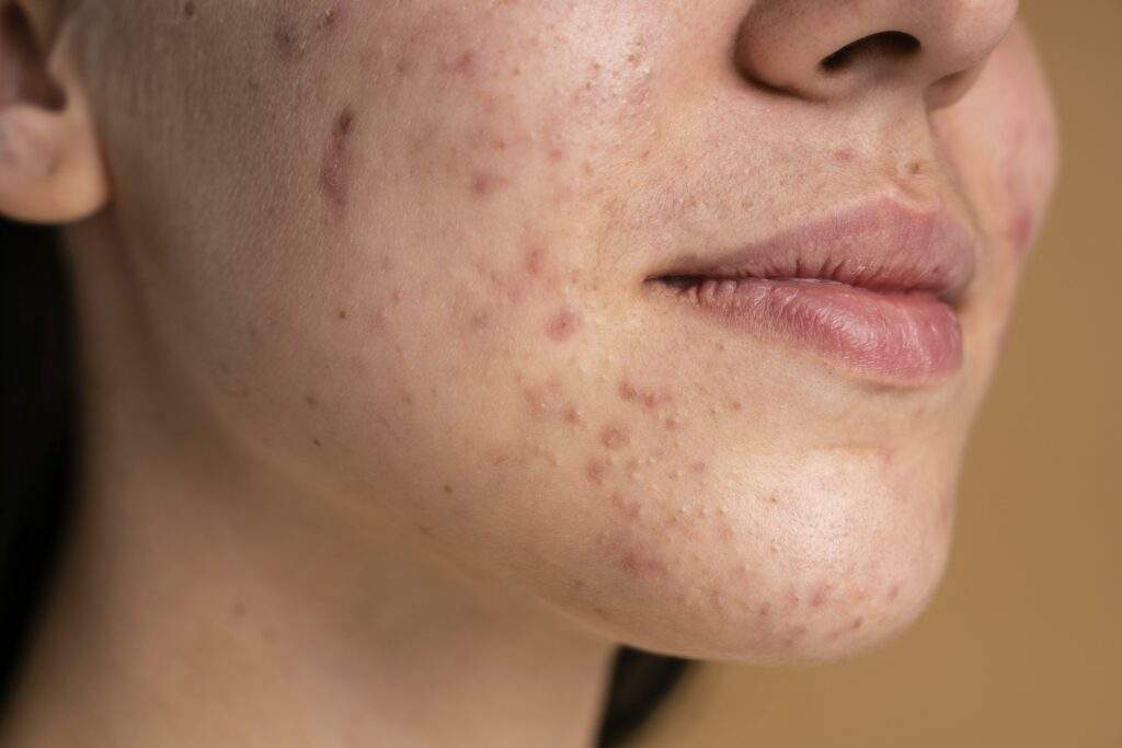 How To Get Rid of Acne Scars: What You Need To Know